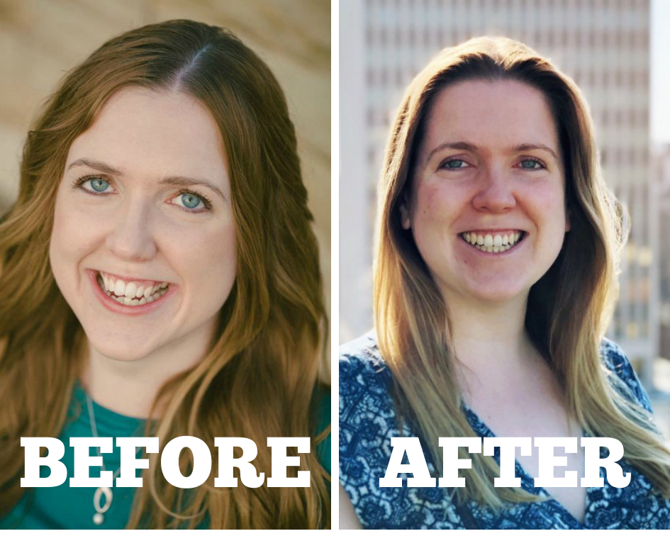 What it's like to recover from double jaw surgery