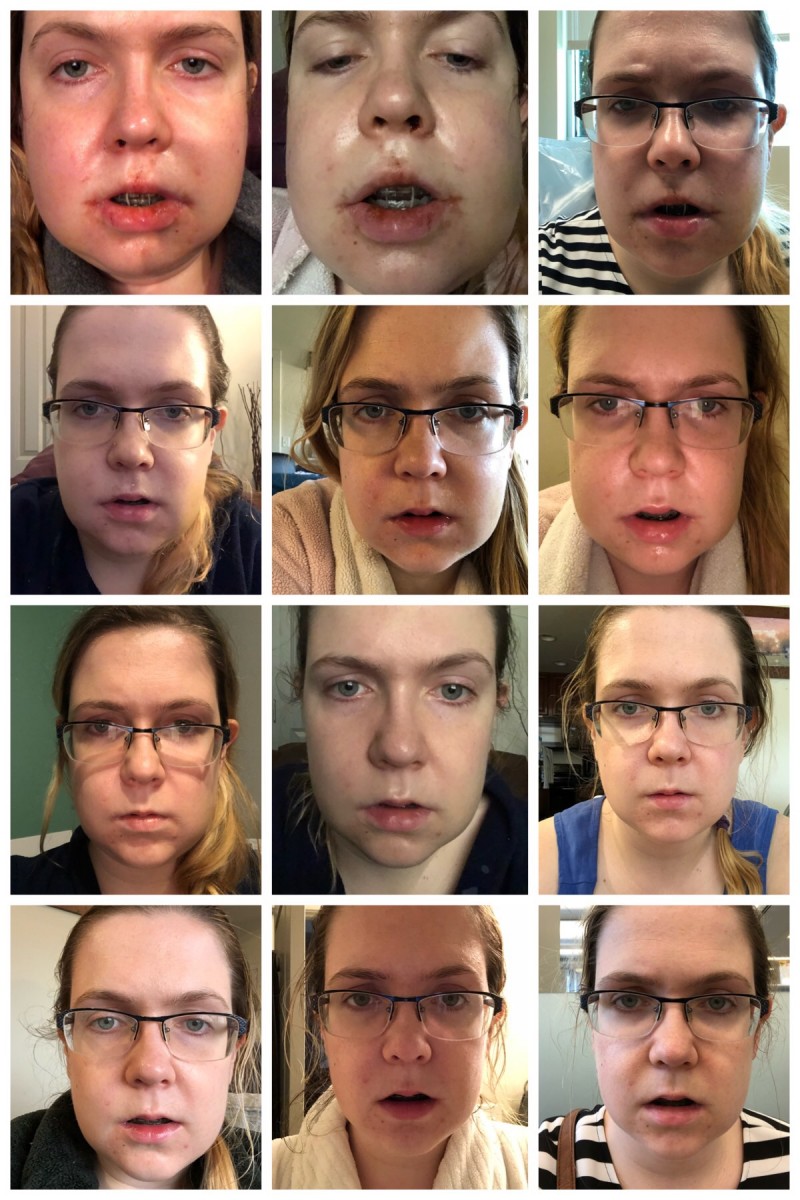 My Double Jaw Surgery Experience: The Good, The Bad, and the (2 weeks post-op) Her Heartland Soul