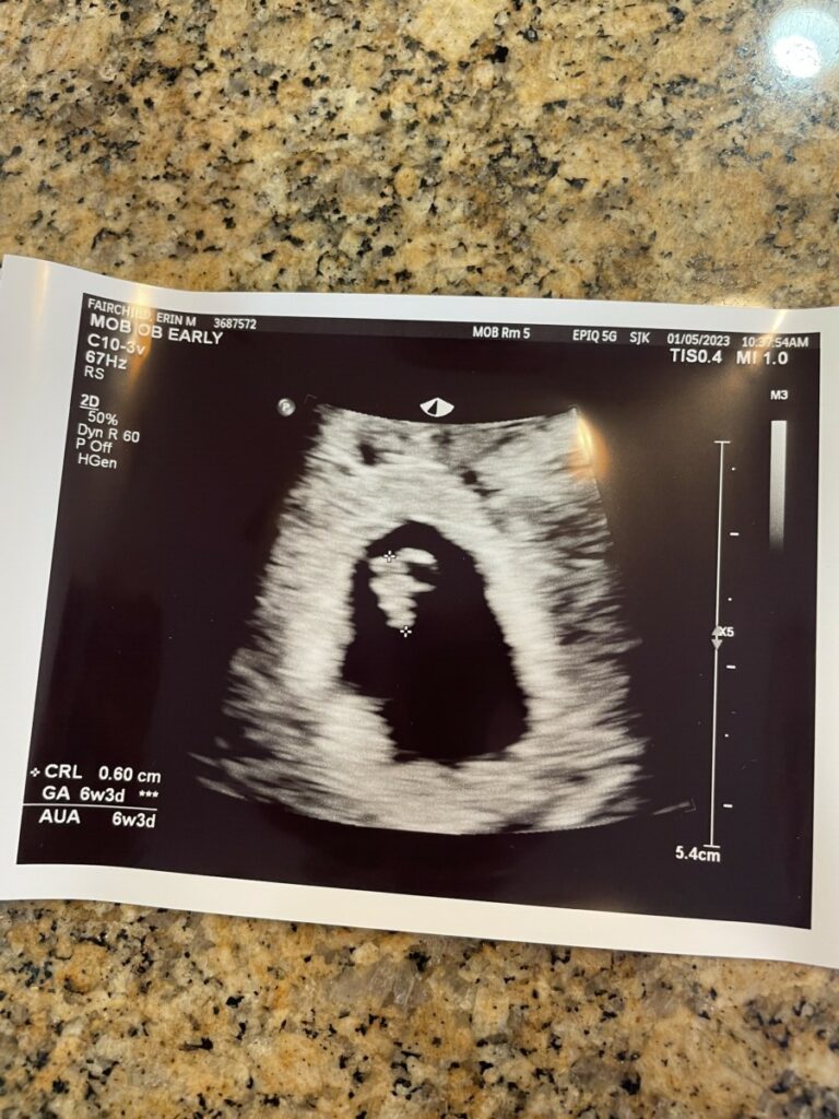 Six week fetus ultrasound